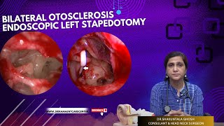 BILATERAL OTOSCLEROSIS ENDOSCOPIC LEFT STAPEDOTOMY  DRSHAKUNTALA GHOSH  SRI RAMA ENT CARE CENTER [upl. by Eneladgam]