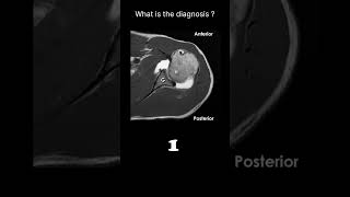 MRI arthrogram – shoulder Quiz 22 radiologychannel007 [upl. by Sands73]