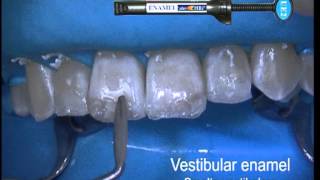 Enamel Plus HRi kerrostusvideo Dr Lorenzo Vanini ENA HRi Kompodent [upl. by Nnyloj]