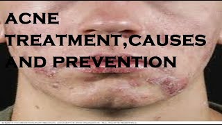 acne treatmentcauses and prevention [upl. by Botnick621]