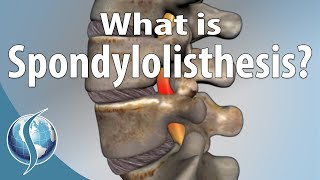 What Is Spondylolisthesis [upl. by Diogenes]