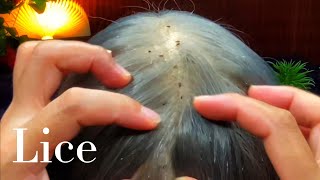 ASMR Scalp Scratching Lice Removal 🥱😴💤 [upl. by Musetta210]