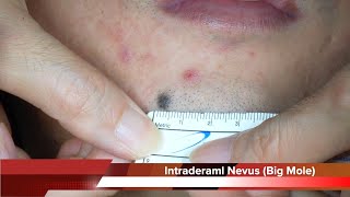 Intradermal Nevus Big Mole Face Removal Surgey HD 얼굴 큰 점 진피내모반 제거 수술 수원 광교 유디트 성형외과 닥터랜사부 [upl. by Asirehc]