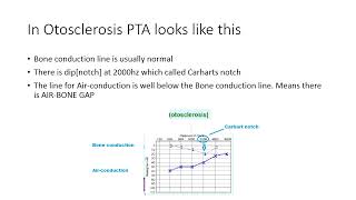 Otosclerosis 4th year [upl. by Naicul222]