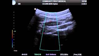 Ultrasound Guided Occipital Nerve Block [upl. by Salhcin]