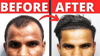 8 Months Hair Transplant Result [upl. by Rorrys]