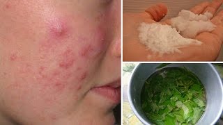 7 Cystic Acne Home Remedies that Really Work [upl. by Nerland131]