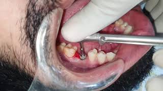 Flapless Implant Placement By Dr Akash Akinwar MDS Mumbai [upl. by Gardie]