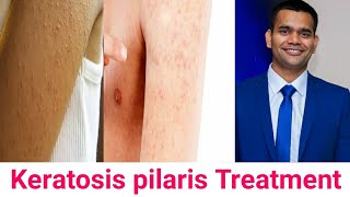 Keratosis Pilaris Cause Symptoms Ayurvedic Treatment [upl. by Livvi]