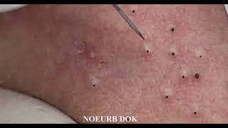 Popping Tons Of Blackheads Part 01 [upl. by Elletnwahs]