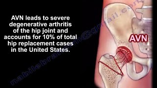 Avascular Necrosis Osteonecrosis  Everything You Need To Know  Dr Nabil Ebraheim [upl. by Billy]