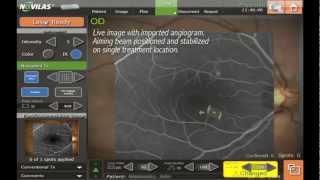 Navilas® Navigated Laser Therapy with William R Freeman MD [upl. by Skillern]