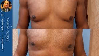 2 WEEKS PostOp❗Gynecomastia VaserLipo Contouring The Long Island JPlasma Center By Dr Lebowitz [upl. by Lexa]