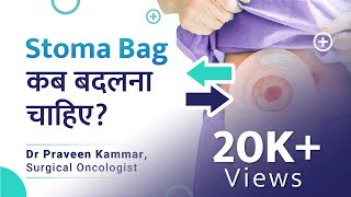 When to change a stoma bag  Stoma bag कब बदलें  Stoma bag  Dr Praveen Kammar OncoSurgeon [upl. by Minne]