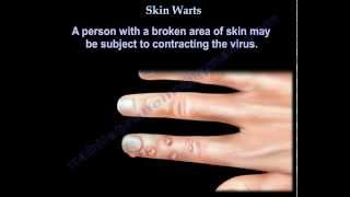 Skin Warts  Hand warts  Everything You Need To Know  Dr Nabil Ebraheim [upl. by Kaliope]