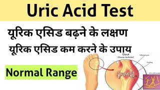 Uric Acid Test in Hindi  uric acid treatment  uric acid symptoms [upl. by Auhoj]