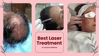 Best Laser treatment at HLCCS RANCHICall now 9334334935 laser skincare beauty laserhairremoval [upl. by Kuhn]