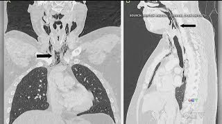 Trying to stifle a sneeze could lead to internal damage [upl. by Magna]