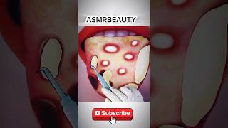 Best Treatment of Tongue infection  ASMR ytshorts youtube [upl. by Ahse]