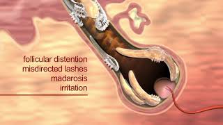 Learn how Demodex mites cause blepharitis [upl. by Christye]