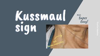 Kussmaul sign SIMPLIFIED FOR CLEAR UNDERSTANDING [upl. by Esirtal867]