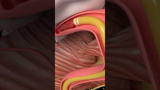 Mechanical Thrombectomy in stroke medicine anatomy science health stroke [upl. by Akirehc]