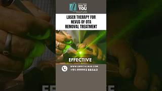 Laser Therapy for Nevus of OTA Removal Treatment  Nevus of OTA Treatment in Delhi  Dr PK Talwar [upl. by Jamaal905]