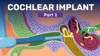 What is A Cochlear Implant  How Hearing Aids and Implants Help Recover Hearing Loss [upl. by Tore20]