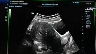 Adenomyosis Ultrasound [upl. by Ahsakal]