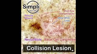 Collision Lesion  MoleNevus and Basal Cell Carcinoma [upl. by Beverlie842]