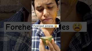 Forehead pimples remove 😫 music skincare alovera tending [upl. by Gibrian]