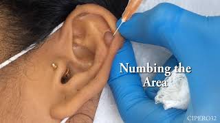 Left Ear Lobe Keloid  Removal [upl. by Enyamert]