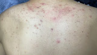 ACNE TREATMENT VU QUYNH MI  Acne On Back FULL [upl. by Jovia609]