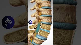 See how Spondylolisthesis affects the Spine in 3D Animation [upl. by Brucie824]