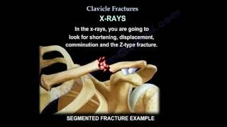 Clavicle Fractures  Everything You Need To Know  Dr Nabil Ebraheim [upl. by Ailaroc]