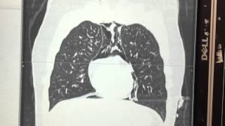 CT scan of chest  pneumopericardium [upl. by Ellerret]