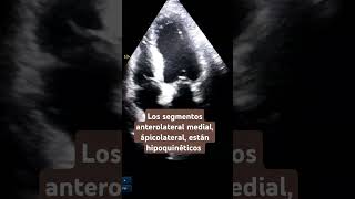 Hipoquinesia anterolateral medial y apical echocardiogram hipoquinesia akinesia infarto [upl. by Weinert]