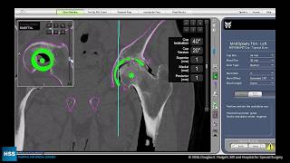 Total Hip Arthroplasty Posterior Approach with Robotic Assistance Part 1 [upl. by Grochow]