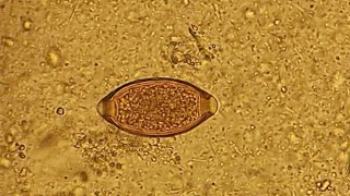 Trichuris trichiura in stool microscopy [upl. by Ahsaret]