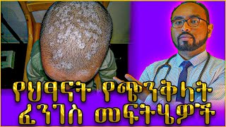 የህፃናት የጭንቅላት ፈንገስ መፍትሄዎች  Dr Fasil [upl. by Albright]