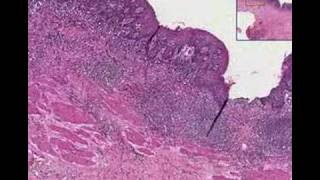 Histopathology EsophagusChronic esophagitis [upl. by Flossi330]