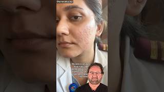 CO2 Laser for Acne Scars  Surgeon Reacts [upl. by Inna988]