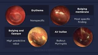 Acute Otitis Media Otoscopic Findings [upl. by Nial]