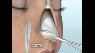 Rinoplastia abierta [upl. by Ebarta163]