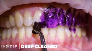 How Teeth Are Professionally Deep Cleaned  Deep Cleaned [upl. by Eitak]