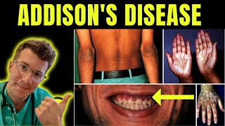 Doctor explains Addisons disease Adrenal insufficiency definition symptoms treatment amp more [upl. by Cinemod]