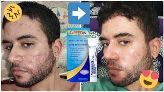 My 4 Months Acne Journey Using Differin Gel before and after [upl. by Tai]