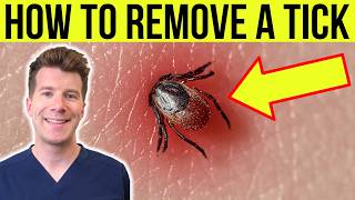 Doctor explains HOW TO REMOVE A TICK  Stepbystep guide [upl. by Nossah161]