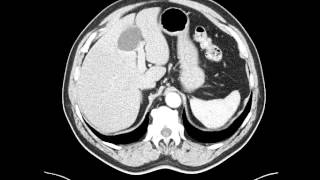 Esophageal leiomyoma distal esophagus  CT [upl. by Mcclimans]