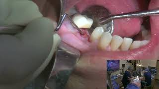 Extraction and Premolar Implant [upl. by Flavius756]